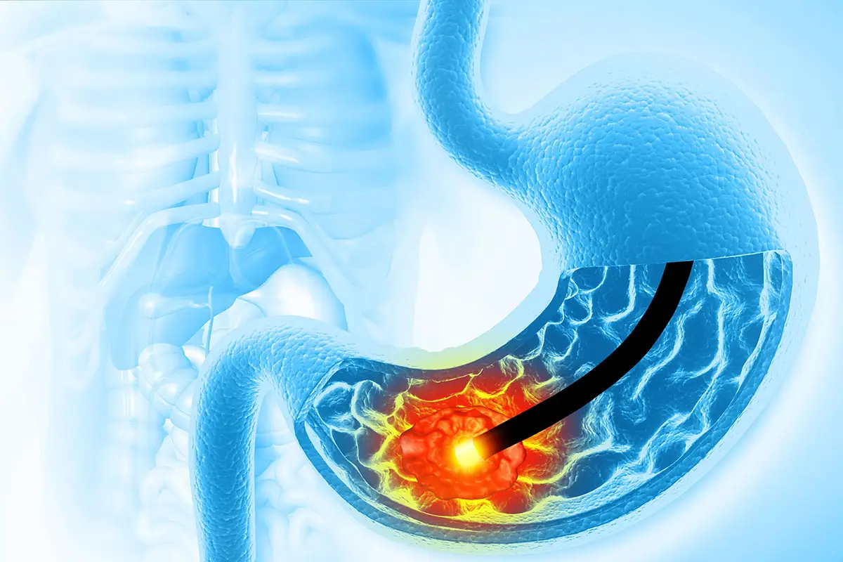 Gastroscopy procedure